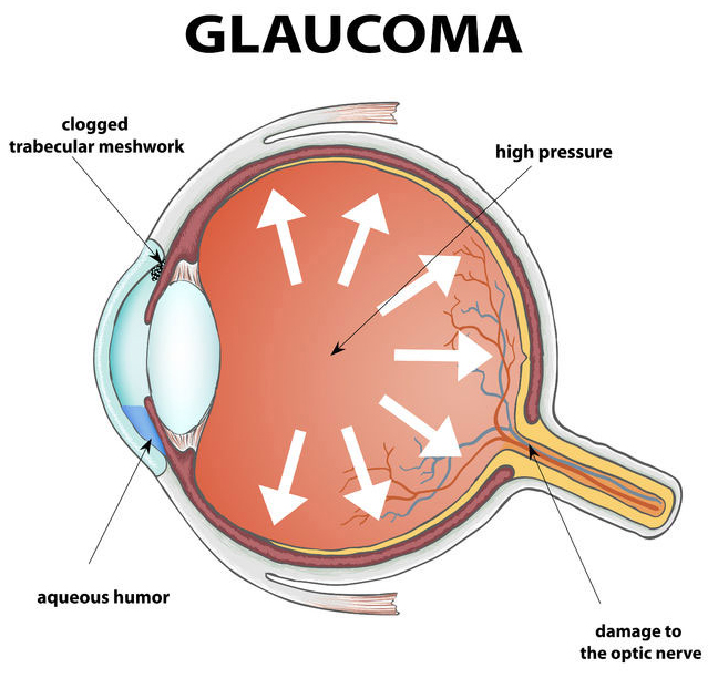 Glaucoma Glaucoma