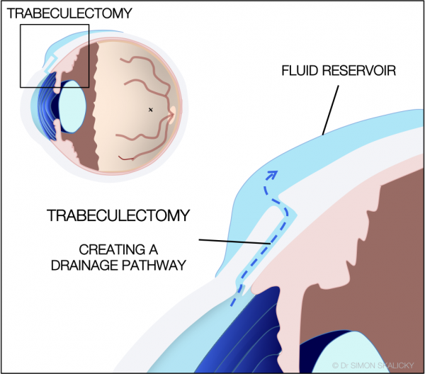 Trabeculectomy Trabeculectomy
